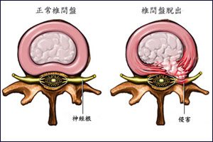 治疗椎间盘突出的三个瑜伽方法