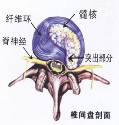 瑜伽如何帮你预防腰间盘突出？